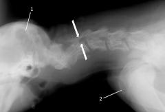 Röntgenaufnahme einer angeborenen Wirbelkanalverengung am Halswirbel